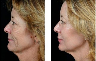 microneedle for wrinkle removal