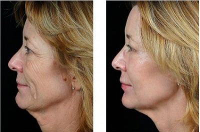 microneedle for wrinkle removal