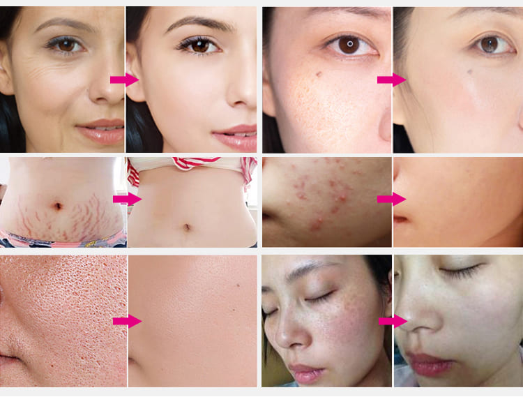 Electric Wireless Microneedling 0-3mm Derma Pen - Before & After